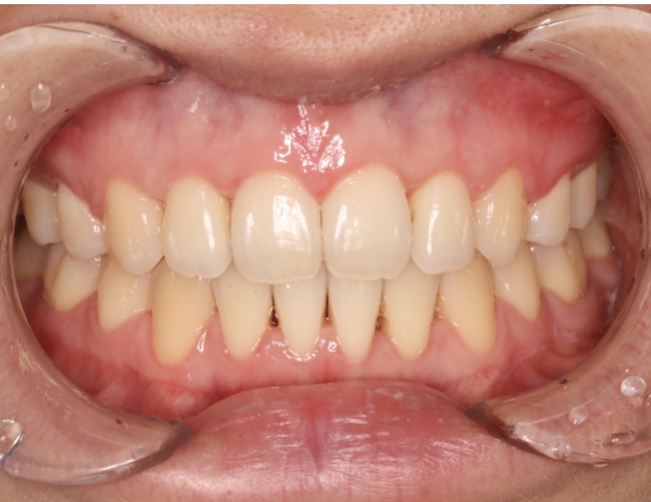 Foto intraoral após o segundo tratamento com Invisalign