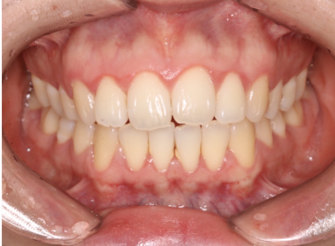 Foto intraoral antes do segundo tratamento com Invisalign